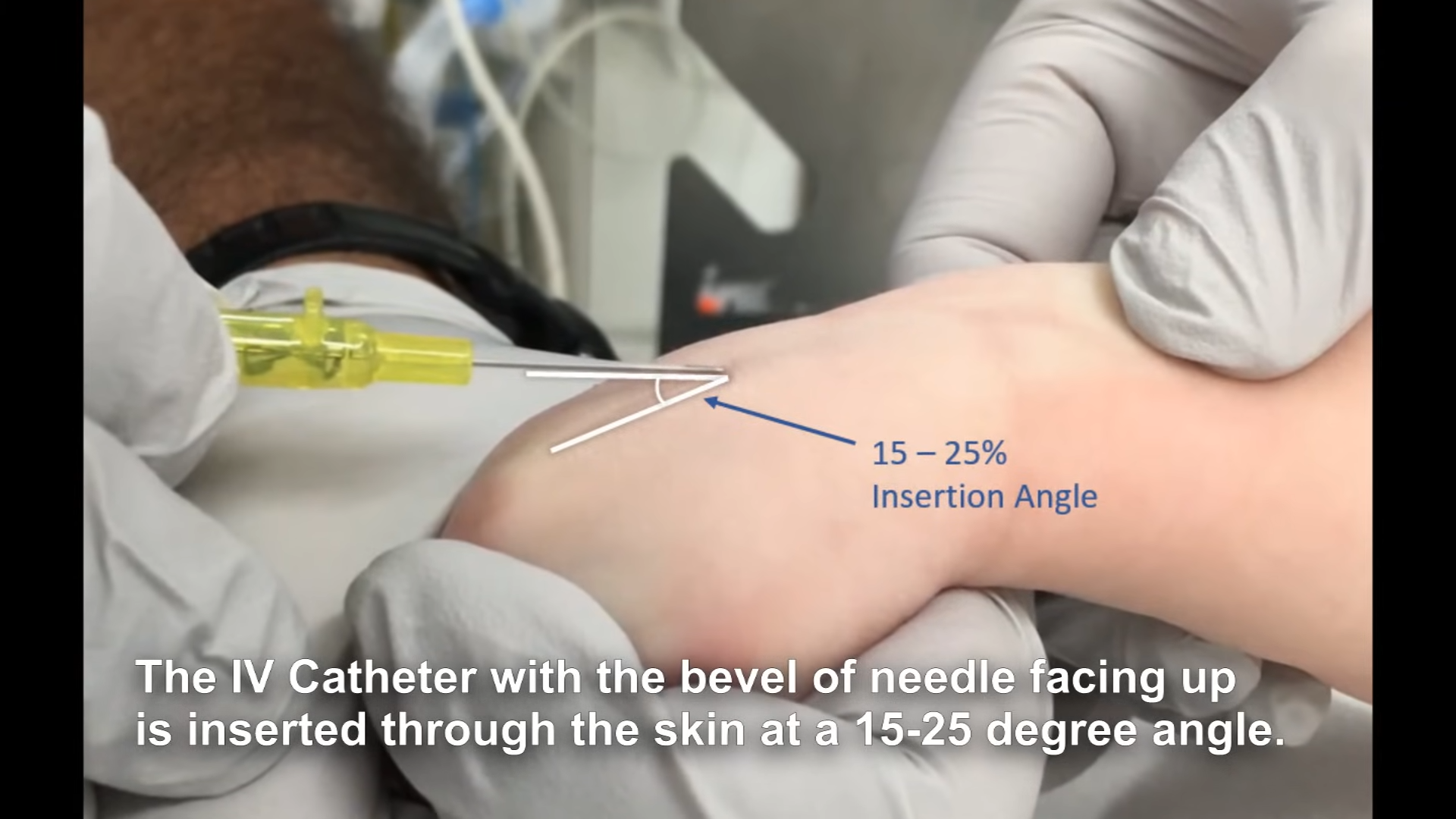 15 to 25 degree insertion angle